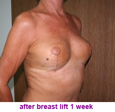 plastic-surgery-breast-lift